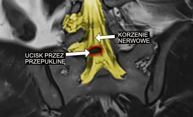 G54 - najpowszechniejsze objawy choroby korzeni i splotów nerwowych G54 - najpowszechniejsze objawy choroby korzeni i splotów nerwowych